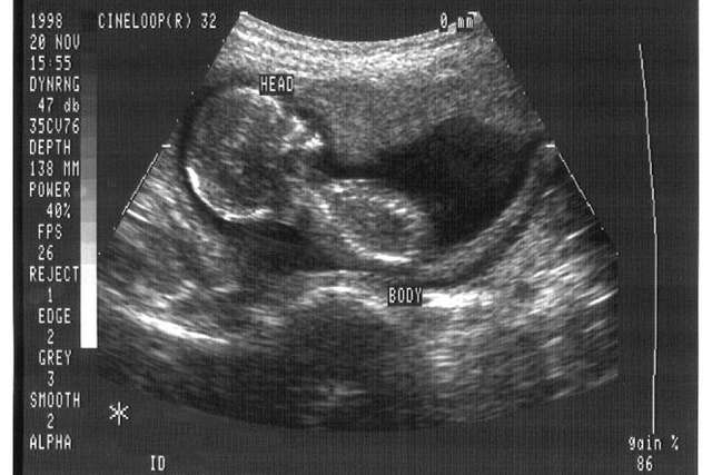 Ohio governor signs 20-week abortion ban, vetoes ‘heartbeat’ measure
